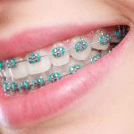 Why Teens Need Braces: A Comprehensive Guide for Parents and Teens why teens need braces